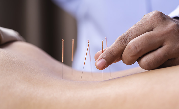 Pessoa colocando as agulhas de acupuntura nas costas de uma mulher.